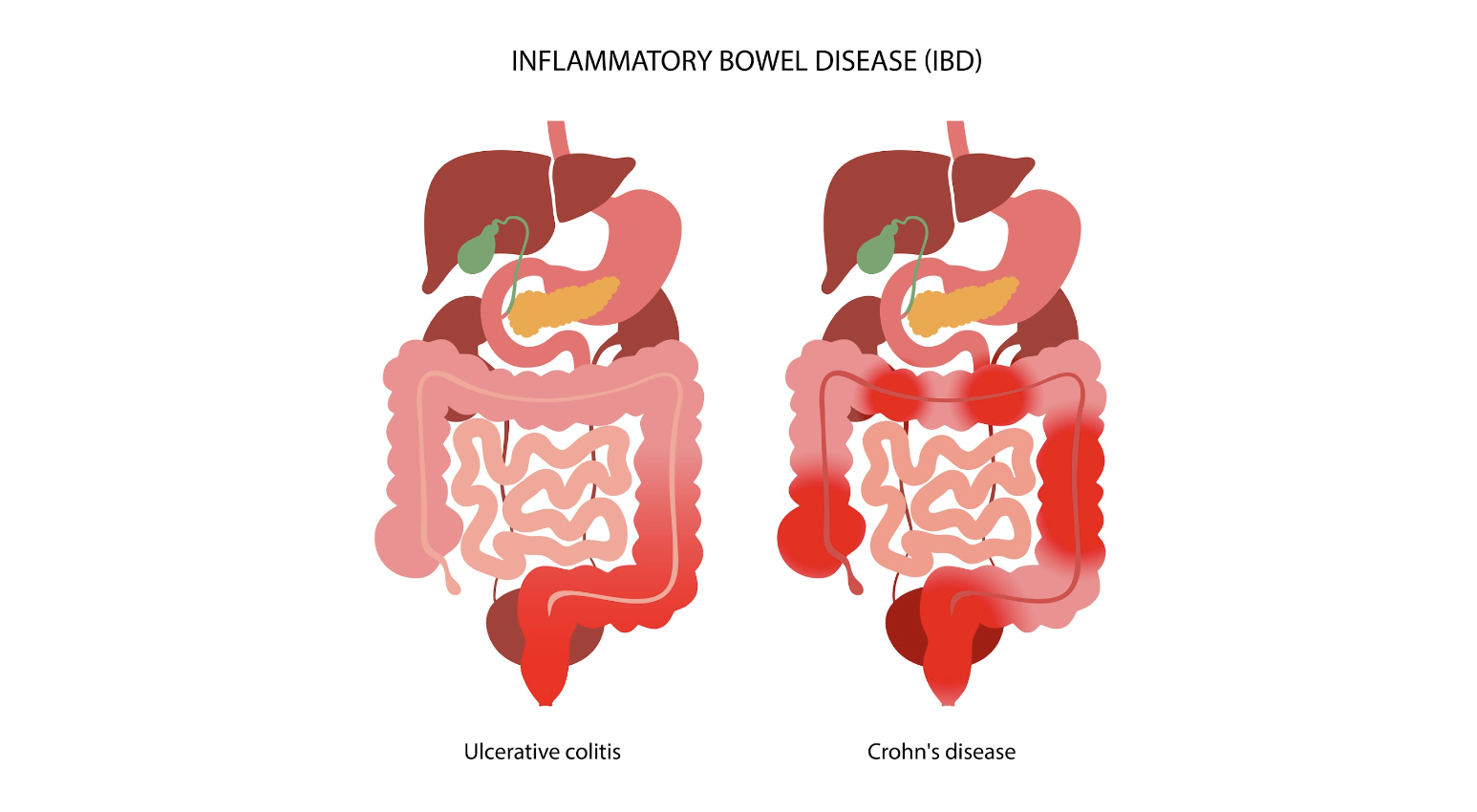 Endometriosis and Inflammatory Bowel Disease: Distinguishing the Differences