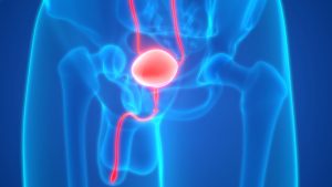 Endometriosis Spread to the Ureter